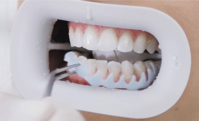 10-Gingiva_entfernen.jpg